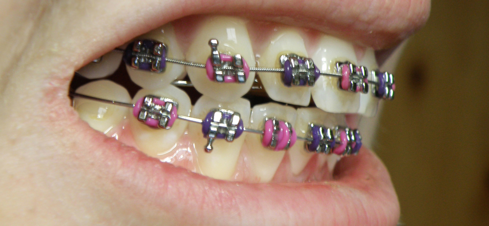 Types of Rubber Brands for Braces and Their Functions