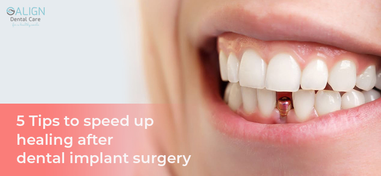 https://www.aligndentalcare.lk/wp-content/uploads/2021/02/5-Tips-to-speed-up-healing-after-dental-implant-surgery.jpg